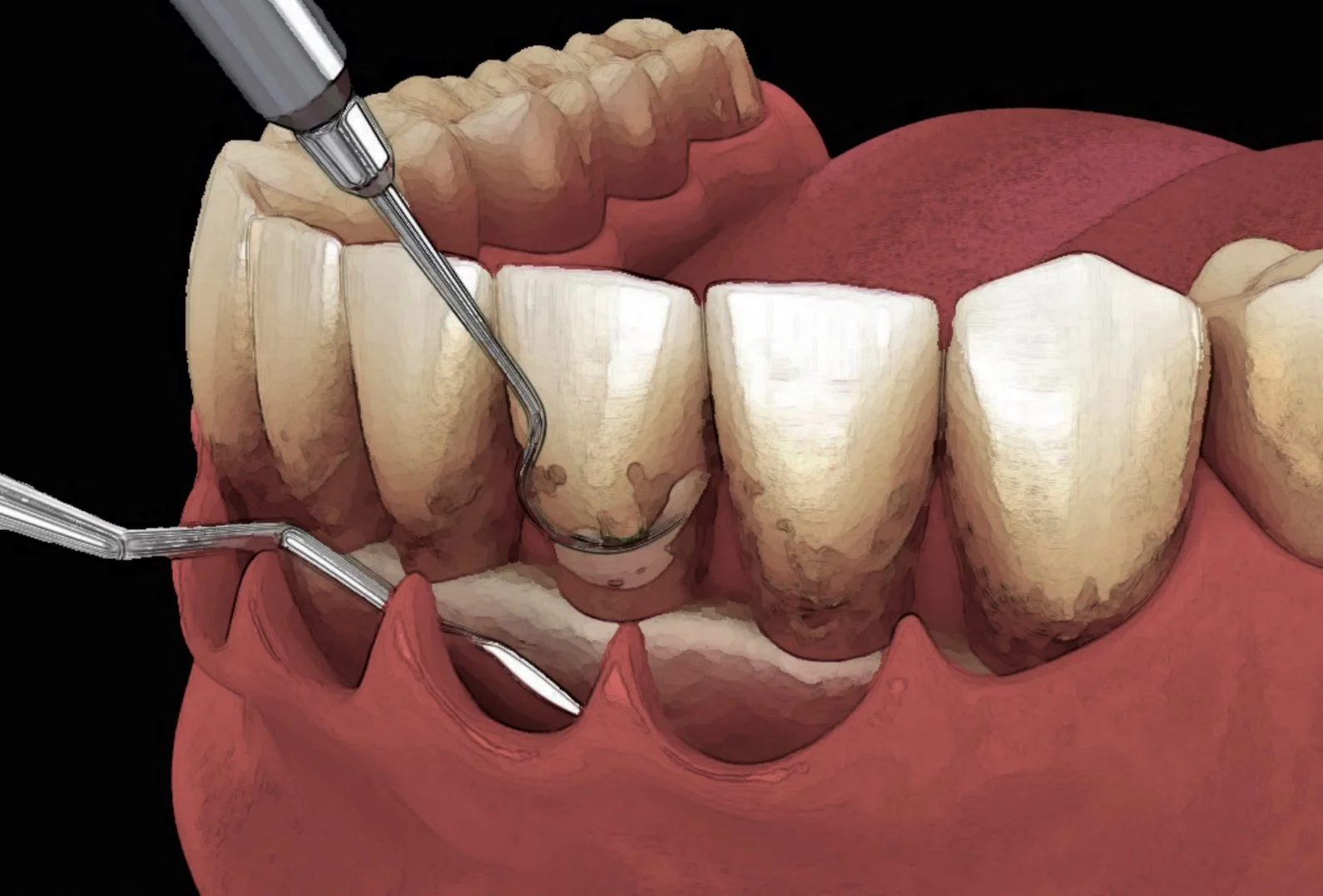 Contemporary Periodontal Treatment Strategies