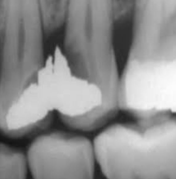 Interdental Septum Syndrome