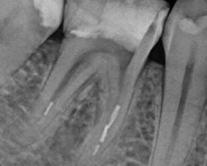 Comprehensive Management of Fractured Endodontic Instruments