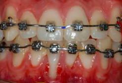 Prévention des récessions gingivales en traitement orthodontique (ODF)