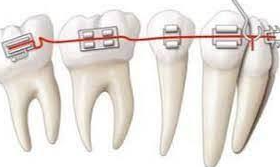 Forces orthodontiques : notions de base