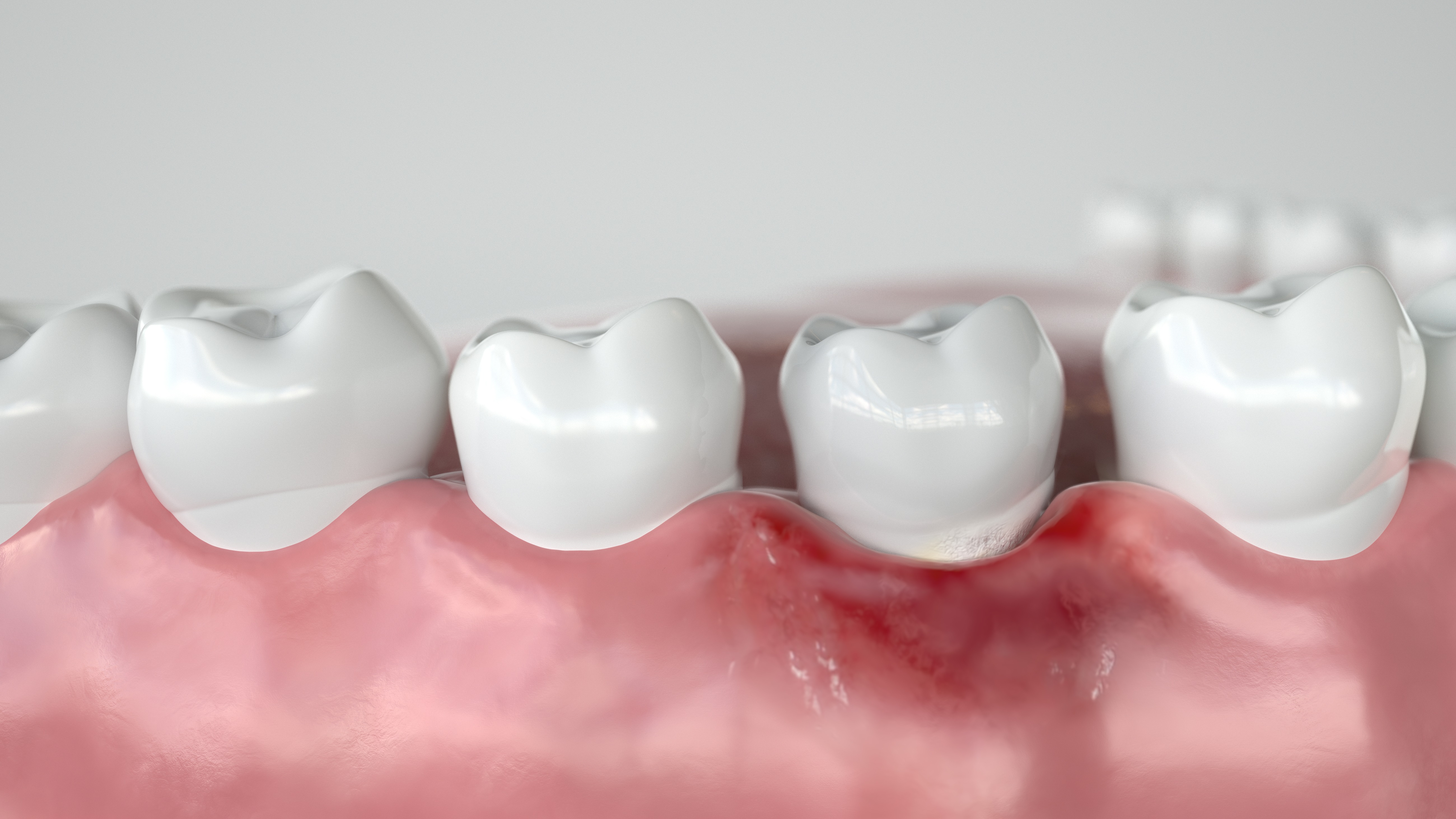 Implant Maintenance and Peri-Implant Diseases: From Mucositis to Peri-Implantitis