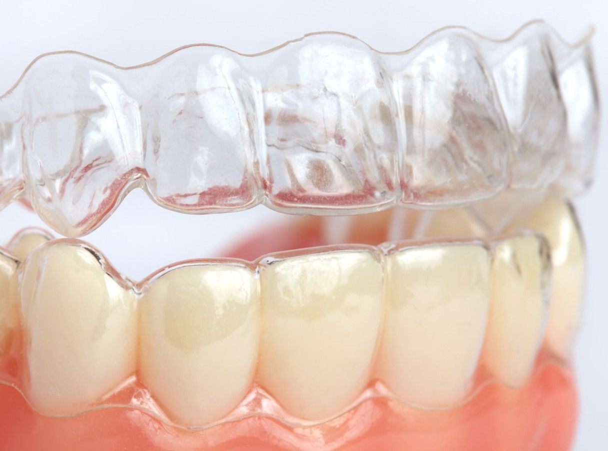 Biomécanique des Aligneurs Transparents chez l'Adulte