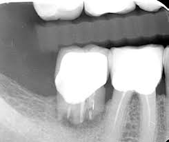 Résorption Radiculaire : Classifications, mécanismes et prise en charge clinique.